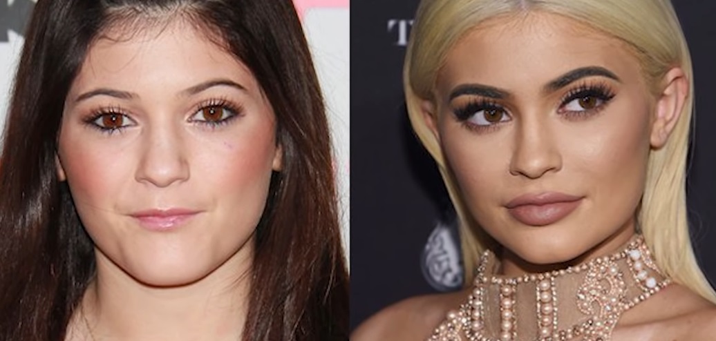 Kylie Jenner Surgery