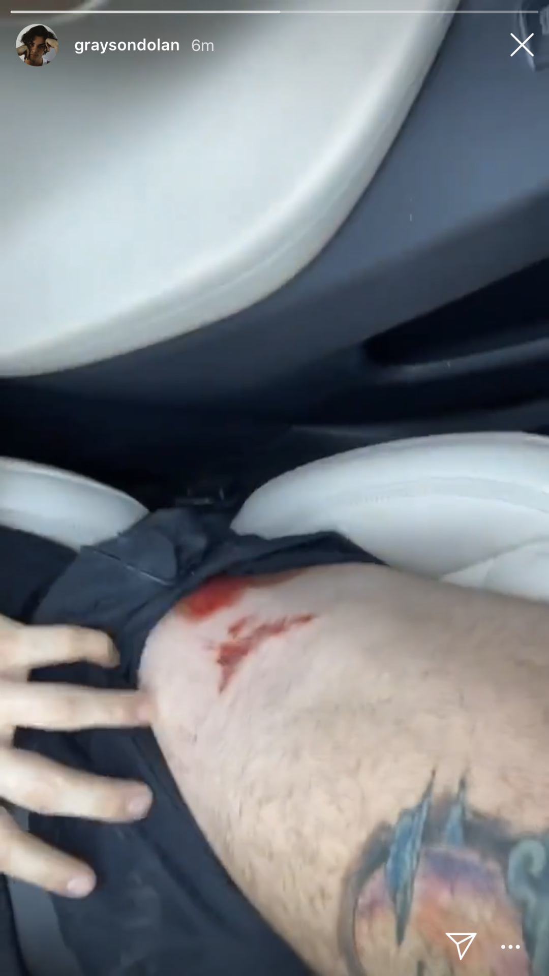 Grayson Dolan injures himself whilst downhill skating 2 bleeding thigh